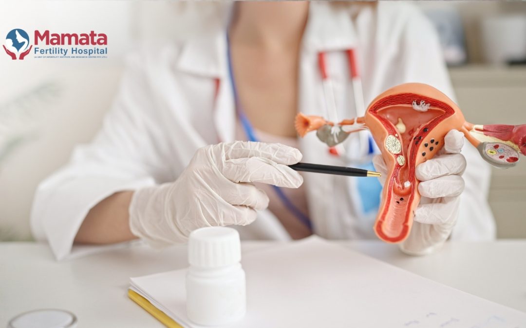Stage 4 endometriosis life expectancy