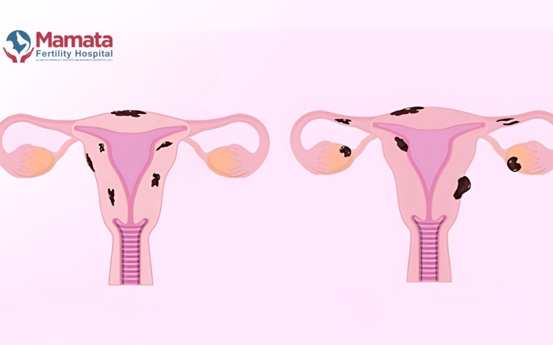 Difference Between Endometriosis and Adenomyosis