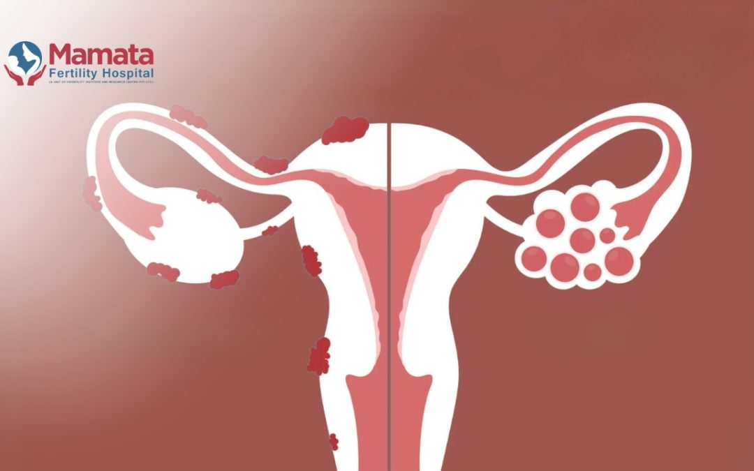PCOS vs Endometriosis, which is worse?