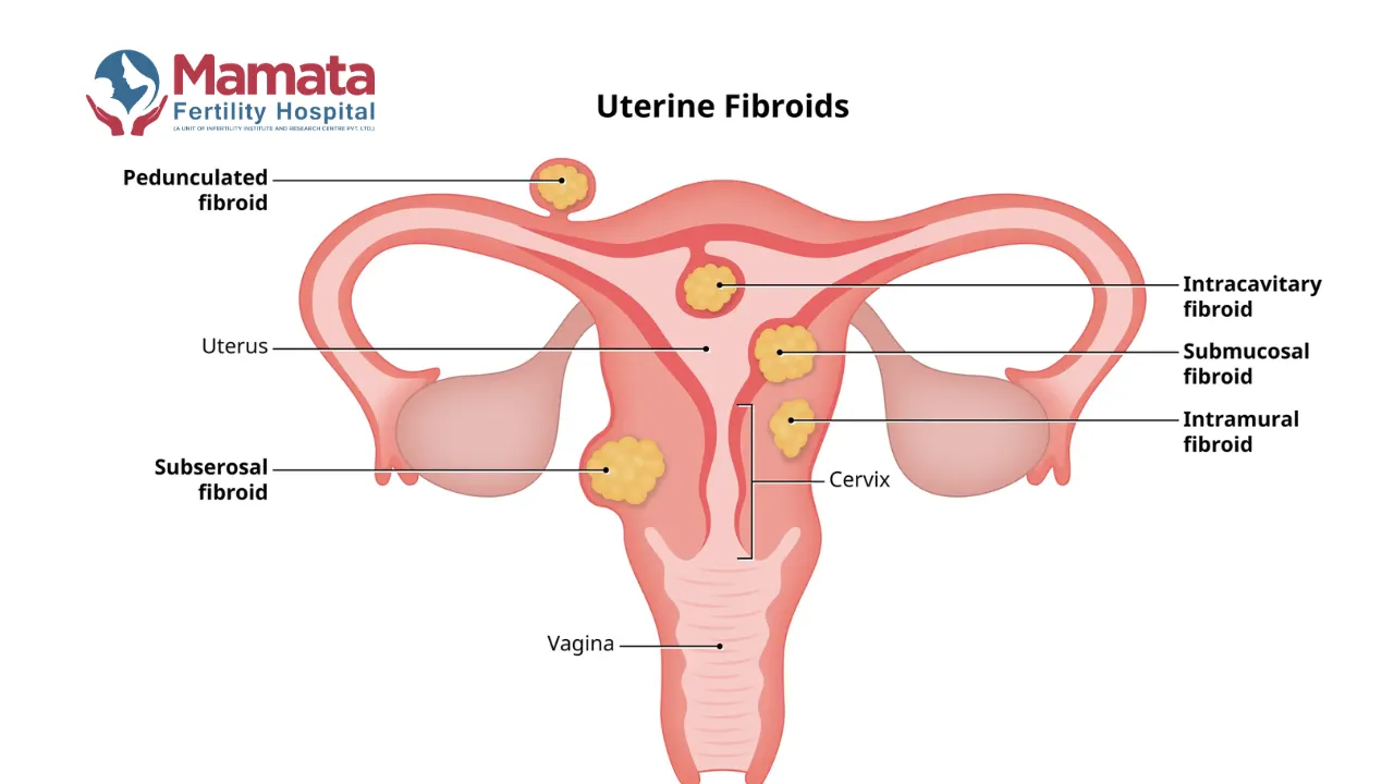 Which Size of Fibroid Is Dangerous